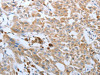 The image on the left is immunohistochemistry of paraffin-embedded Human lung cancer tissue using CSB-PA954065 (FGF1 Antibody) at dilution 1/50, on the right is treated with synthetic peptide. (Original magnification: ×200)