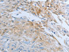 The image on the left is immunohistochemistry of paraffin-embedded Human esophagus cancer tissue using CSB-PA449957 (FGF1 Antibody) at dilution 1/25, on the right is treated with synthetic peptide. (Original magnification: ×200)