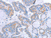 The image on the left is immunohistochemistry of paraffin-embedded Human thyroid cancer tissue using CSB-PA910266 (FGF4 Antibody) at dilution 1/40, on the right is treated with synthetic peptide. (Original magnification: ×200)