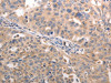The image on the left is immunohistochemistry of paraffin-embedded Human lung cancer tissue using CSB-PA277795 (BGLAP Antibody) at dilution 1/60, on the right is treated with synthetic peptide. (Original magnification: ×200)
