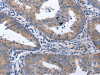 The image on the left is immunohistochemistry of paraffin-embedded Human cervical cancer tissue using CSB-PA447744 (NPPB Antibody) at dilution 1/40, on the right is treated with synthetic peptide. (Original magnification: ×200)