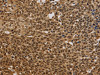 The image on the left is immunohistochemistry of paraffin-embedded Human cervical cancer tissue using CSB-PA587286 (BRAF Antibody) at dilution 1/30, on the right is treated with synthetic peptide. (Original magnification: ×200)