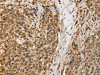 The image on the left is immunohistochemistry of paraffin-embedded Human cervical cancer tissue using CSB-PA163656 (BRAF Antibody) at dilution 1/30, on the right is treated with synthetic peptide. (Original magnification: ×200)