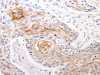 The image on the left is immunohistochemistry of paraffin-embedded Human esophagus cancer tissue using CSB-PA105805 (DFFB Antibody) at dilution 1/30, on the right is treated with synthetic peptide. (Original magnification: ×200) The image on the left is immunohistochemistry of paraffin-embedded Human esophagus cancer tissue using CSB-PA105805 (DFFB Antibody) at dilution 1/30, on the right is treated with synthetic peptide. (Original magnification: ×200)