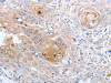 The image on the left is immunohistochemistry of paraffin-embedded Human esophagus cancer tissue using CSB-PA041334 (CASP12 Antibody) at dilution 1/50, on the right is treated with synthetic peptide. (Original magnification: ×200)