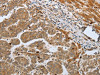 The image on the left is immunohistochemistry of paraffin-embedded Human liver cancer tissue using CSB-PA291244 (CASP12 Antibody) at dilution 1/50, on the right is treated with synthetic peptide. (Original magnification: ×200)
