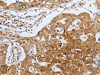 The image on the left is immunohistochemistry of paraffin-embedded Human lung cancer tissue using CSB-PA291244 (CASP12 Antibody) at dilution 1/50, on the right is treated with synthetic peptide. (Original magnification: ×200)