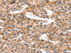 The image on the left is immunohistochemistry of paraffin-embedded Human liver cancer tissue using CSB-PA694879 (RUNX2 Antibody) at dilution 1/20, on the right is treated with synthetic peptide. (Original magnification: ×200)