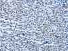The image on the left is immunohistochemistry of paraffin-embedded Human ovarian cancer tissue using CSB-PA712321 (CBX1 Antibody) at dilution 1/30, on the right is treated with synthetic peptide. (Original magnification: ×200)