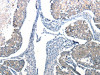 The image on the left is immunohistochemistry of paraffin-embedded Human breast cancer tissue using CSB-PA035138 (Ccl6 Antibody) at dilution 1/50, on the right is treated with synthetic peptide. (Original magnification: ×200)