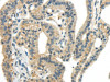 The image on the left is immunohistochemistry of paraffin-embedded Human thyroid cancer tissue using CSB-PA908097 (CCL13 Antibody) at dilution 1/40, on the right is treated with synthetic peptide. (Original magnification: ×200)