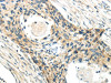 The image on the left is immunohistochemistry of paraffin-embedded Human esophagus cancer tissue using CSB-PA908097 (CCL13 Antibody) at dilution 1/40, on the right is treated with synthetic peptide. (Original magnification: ×200)