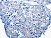 The image on the left is immunohistochemistry of paraffin-embedded Human breast cancer tissue using CSB-PA662351 (CCL2 Antibody) at dilution 1/50, on the right is treated with synthetic peptide. (Original magnification: ×200)
