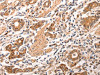 The image on the left is immunohistochemistry of paraffin-embedded Human gastric cancer tissue using CSB-PA113746 (CCL17 Antibody) at dilution 1/70, on the right is treated with synthetic peptide. (Original magnification: ×200) The image on the left is immunohistochemistry of paraffin-embedded Human gastric cancer tissue using CSB-PA113746 (CCL17 Antibody) at dilution 1/70, on the right is treated with synthetic peptide. (Original magnification: ×200)