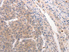 The image on the left is immunohistochemistry of paraffin-embedded Human breast cancer tissue using CSB-PA160889 (CDC37 Antibody) at dilution 1/20, on the right is treated with synthetic peptide. (Original magnification: ×200)