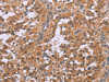 The image on the left is immunohistochemistry of paraffin-embedded Human thyroid cancer tissue using CSB-PA952871 (CDK1 Antibody) at dilution 1/20, on the right is treated with synthetic peptide. (Original magnification: ×200)