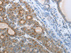 The image on the left is immunohistochemistry of paraffin-embedded Human thyroid cancer tissue using CSB-PA109108 (CEACAM5 Antibody) at dilution 1/25, on the right is treated with synthetic peptide. (Original magnification: ×200)