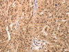 The image on the left is immunohistochemistry of paraffin-embedded Human breast cancer tissue using CSB-PA153426 (JUND Antibody) at dilution 1/60, on the right is treated with synthetic peptide. (Original magnification: ×200) The image on the left is immunohistochemistry of paraffin-embedded Human breast cancer tissue using CSB-PA153426 (JUND Antibody) at dilution 1/60, on the right is treated with synthetic peptide. (Original magnification: ×200)