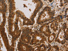 The image on the left is immunohistochemistry of paraffin-embedded Human colon cancer tissue using CSB-PA099774 (CSNK2B Antibody) at dilution 1/30, on the right is treated with synthetic peptide. (Original magnification: ×200)