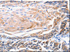 The image on the left is immunohistochemistry of paraffin-embedded Human cervical cancer tissue using CSB-PA376378 (KRT5 Antibody) at dilution 1/25, on the right is treated with synthetic peptide. (Original magnification: ×200)