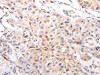 The image on the left is immunohistochemistry of paraffin-embedded Human breast cancer tissue using CSB-PA181038 (KRT6A/KRT6B/KRT6C/KRT6B/KRT6C Antibody) at dilution 1/40, on the right is treated with synthetic peptide. (Original magnification: ×200)