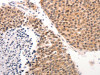 The image on the left is immunohistochemistry of paraffin-embedded Human ovarian cancer tissue using CSB-PA937892 (KRT6A/KRT6B/KRT6C Antibody) at dilution 1/50, on the right is treated with synthetic peptide. (Original magnification: ×200)