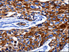 The image on the left is immunohistochemistry of paraffin-embedded Human esophagus cancer tissue using CSB-PA111162 (KRT10 Antibody) at dilution 1/25, on the right is treated with synthetic peptide. (Original magnification: ×200)