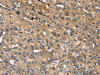 The image on the left is immunohistochemistry of paraffin-embedded Human liver cancer tissue using CSB-PA285156 (INS Antibody) at dilution 1/35, on the right is treated with synthetic peptide. (Original magnification: ×200)