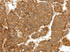 The image on the left is immunohistochemistry of paraffin-embedded Human lung cancer tissue using CSB-PA972442 (COL4A1 Antibody) at dilution 1/30, on the right is treated with synthetic peptide. (Original magnification: ×200)