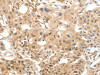 The image on the left is immunohistochemistry of paraffin-embedded Human breast cancer tissue using CSB-PA972442 (COL4A1 Antibody) at dilution 1/30, on the right is treated with synthetic peptide. (Original magnification: ×200)