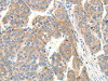 The image on the left is immunohistochemistry of paraffin-embedded Human ovarian cancer tissue using CSB-PA294012 (COL4A1 Antibody) at dilution 1/30, on the right is treated with synthetic peptide. (Original magnification: ×200)