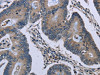 The image on the left is immunohistochemistry of paraffin-embedded Human colon cancer tissue using CSB-PA065045 (GJC2 Antibody) at dilution 1/40, on the right is treated with synthetic peptide. (Original magnification: ×200)