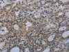 The image on the left is immunohistochemistry of paraffin-embedded Human thyroid cancer tissue using CSB-PA065045 (GJC2 Antibody) at dilution 1/40, on the right is treated with synthetic peptide. (Original magnification: ×200)
