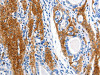 The image on the left is immunohistochemistry of paraffin-embedded Human stomach cancer tissue using CSB-PA076907 (AQP1 Antibody) at dilution 1/5, on the right is treated with synthetic peptide. (Original magnification: ×200)