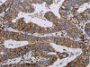 The image on the left is immunohistochemistry of paraffin-embedded Human colon cancer tissue using CSB-PA579941 (AQP4 Antibody) at dilution 1/20, on the right is treated with synthetic peptide. (Original magnification: ×200)