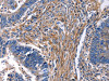 The image on the left is immunohistochemistry of paraffin-embedded Human rectal cancer tissue using CSB-PA158258 (CXCR5 Antibody) at dilution 1/25, on the right is treated with synthetic peptide. (Original magnification: ×200)