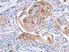 The image on the left is immunohistochemistry of paraffin-embedded Human esophagus cancer tissue using CSB-PA092112 (CX3CL1 Antibody) at dilution 1/30, on the right is treated with synthetic peptide. (Original magnification: ×200)