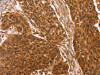 The image on the left is immunohistochemistry of paraffin-embedded Human esophagus cancer tissue using CSB-PA098232 (CCND2 Antibody) at dilution 1/25, on the right is treated with synthetic peptide. (Original magnification: ×200)