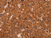 The image on the left is immunohistochemistry of paraffin-embedded Human liver cancer tissue using CSB-PA975999 (CCND3 Antibody) at dilution 1/40, on the right is treated with synthetic peptide. (Original magnification: ×200)
