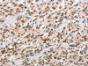 The image on the left is immunohistochemistry of paraffin-embedded Human esophagus cancer tissue using CSB-PA940399 (CCNT1 Antibody) at dilution 1/20, on the right is treated with synthetic peptide. (Original magnification: ×200)