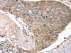 The image on the left is immunohistochemistry of paraffin-embedded Human esophagus cancer tissue using CSB-PA229173 (LAMP3 Antibody) at dilution 1/20, on the right is treated with synthetic peptide. (Original magnification: ×200)