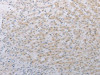 The image on the left is immunohistochemistry of paraffin-embedded Human liver cancer tissue using CSB-PA171204 (LY75 Antibody) at dilution 1/25, on the right is treated with synthetic peptide. (Original magnification: ×200)