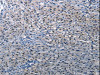 The image on the left is immunohistochemistry of paraffin-embedded Human liver cancer tissue using CSB-PA094273 (DEFA1 Antibody) at dilution 1/10, on the right is treated with synthetic peptide. (Original magnification: ×200) The image on the left is immunohistochemistry of paraffin-embedded Human liver cancer tissue using CSB-PA094273 (DEFA1 Antibody) at dilution 1/10, on the right is treated with synthetic peptide. (Original magnification: ×200)