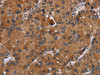 The image on the left is immunohistochemistry of paraffin-embedded Human liver cancer tissue using CSB-PA580837 (DISC1 Antibody) at dilution 1/20, on the right is treated with synthetic peptide. (Original magnification: ×200) The image on the left is immunohistochemistry of paraffin-embedded Human liver cancer tissue using CSB-PA580837 (DISC1 Antibody) at dilution 1/20, on the right is treated with synthetic peptide. (Original magnification: ×200)