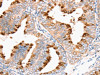 The image on the left is immunohistochemistry of paraffin-embedded Human cervical cancer tissue using CSB-PA106123 (DNMT1 Antibody) at dilution 1/35, on the right is treated with synthetic peptide. (Original magnification: ×200)