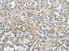 The image on the left is immunohistochemistry of paraffin-embedded Human thyroid cancer tissue using CSB-PA199904 (TRDMT1 Antibody) at dilution 1/40, on the right is treated with synthetic peptide. (Original magnification: ×200)
