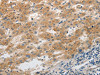 The image on the left is immunohistochemistry of paraffin-embedded Human liver cancer tissue using CSB-PA109577 (SLC1A2 Antibody) at dilution 1/20, on the right is treated with synthetic peptide. (Original magnification: ×200)