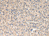 The image on the left is immunohistochemistry of paraffin-embedded Human liver cancer tissue using CSB-PA521183 (SLC1A1 Antibody) at dilution 1/30, on the right is treated with synthetic peptide. (Original magnification: ×200)