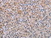 The image on the left is immunohistochemistry of paraffin-embedded Human prostate cancer tissue using CSB-PA288814 (SLC1A6 Antibody) at dilution 1/40, on the right is treated with synthetic peptide. (Original magnification: ×200)