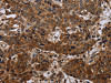 The image on the left is immunohistochemistry of paraffin-embedded Human liver cancer tissue using CSB-PA942193 (SLC1A6 Antibody) at dilution 1/40, on the right is treated with synthetic peptide. (Original magnification: ×200)